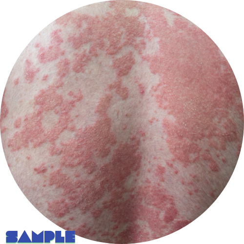 psoriasis sample