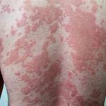 Psoriasis